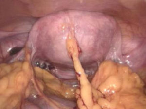 Endometriose e menstruação